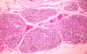 CARCINOMINUM